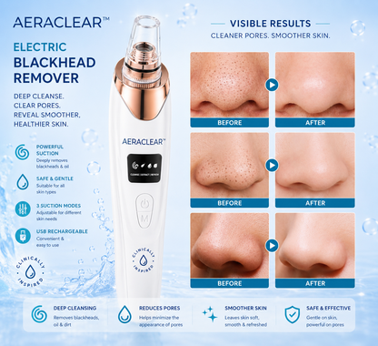 AeraClear Electric Blackhead Remover Vacuum